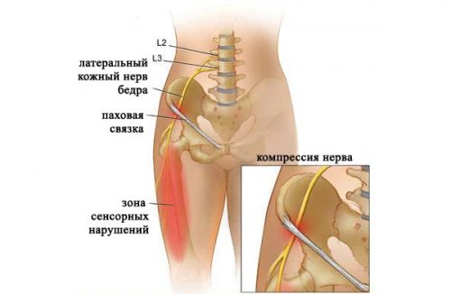 Схема болезни Рота