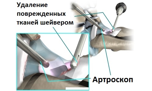 Артроскопический дебридмент