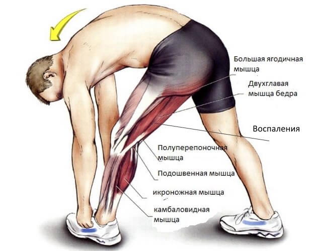 Энтезопатия мышц, сухожилий и связок