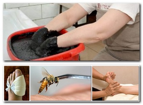 Физиотерапия при подагре суставов Физиотерапия при подагре суставов