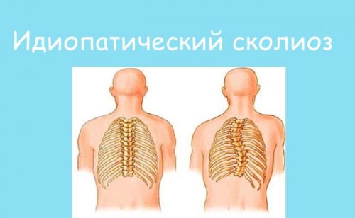 Идиопатический сколиоз позвоночника