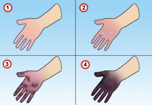 Некроз кожи Некроз кожи