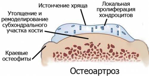 Остеоартроз