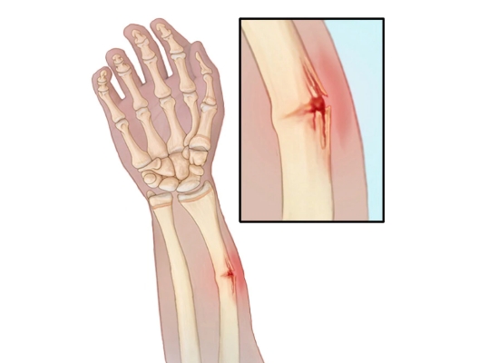 Поднадкостничный перелом по типу зеленой веточки Поднадкостничный перелом по типу зеленой веточки