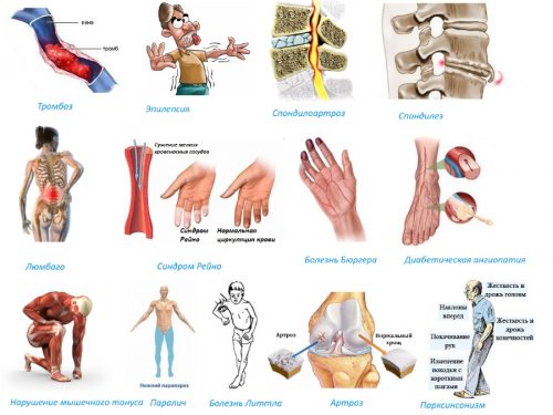 Показания для приема Толперизона Показания для приема Толперизона