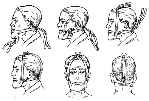 Пращевидная повязка для челюсти Пращевидная повязка для челюсти