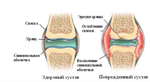 Синовит коленного сустава