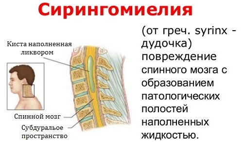 Суть сирингомиелии