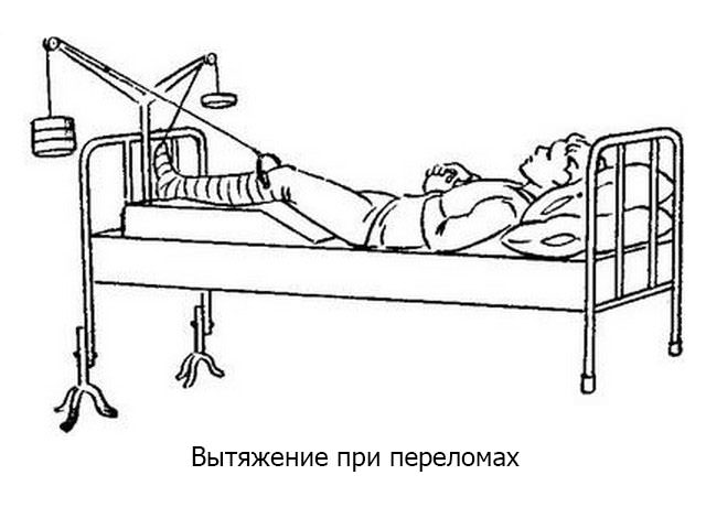 Скелетное вытяжение для сращивания переломов