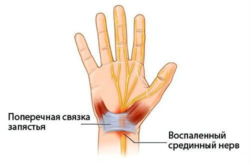 Стилоидит запястья