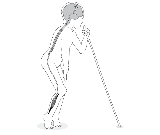 Заболевание тетрапарез