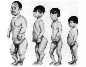 Внешний вид человека с несовершенным остеогенезом Внешний вид человека с несовершенным остеогенезом