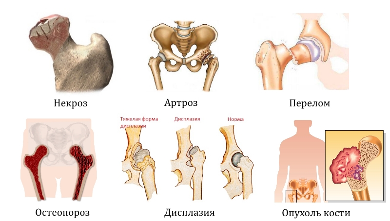 Заболевания и травмы тазобедренного сустава