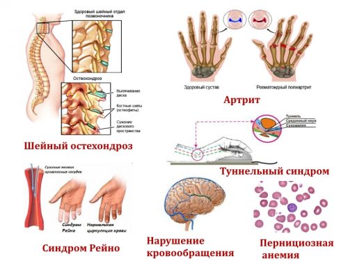 Заболевания — причины онемения