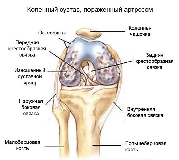Артроз коленного сустава