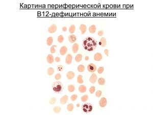 B12 анемия