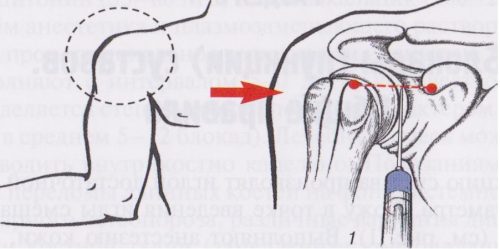 Блокада боли плечевого сустава Блокада боли плечевого сустава