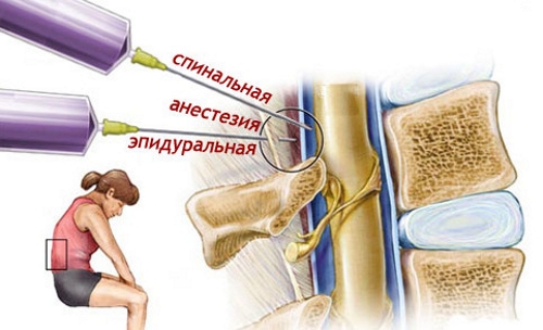 Спинальная и эпидуральная анестезия