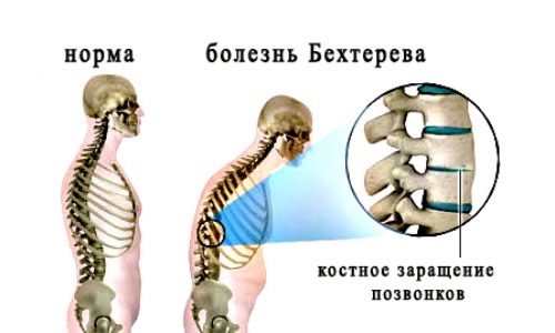 Болезнь Бехтерева