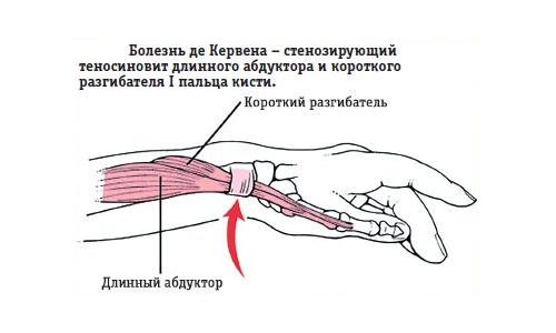 Болезнь де Кервена