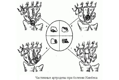 Частичные артодезы при болезни Кинбека