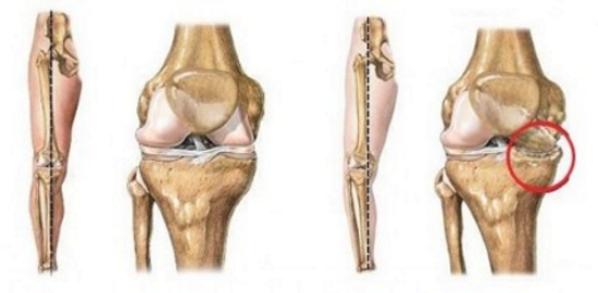 Деформирующий артроз колена