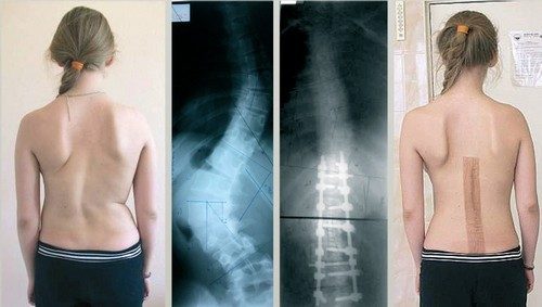 До и после операции при сколиозе До и после операции при сколиозе