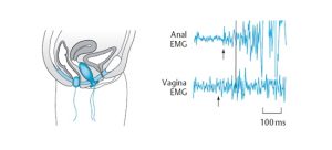 Электромиография таза Электромиография таза