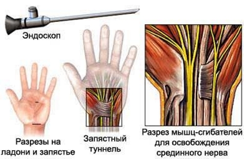 Эндоскопия лучезапястного сустава