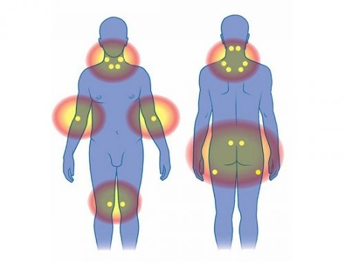 Мышечно-суставная фибромиалгия Мышечно-суставная фибромиалгия