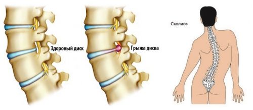 Показания к вертеброревитологии Показания к вертеброревитологии