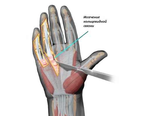 Хирургическое лечение камптодактилии Хирургическое лечение камптодактилии