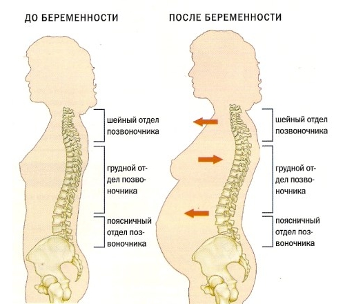 Лордоз при беременности