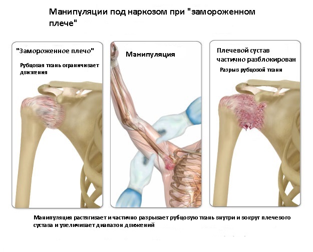 Манипуляции при замороженном плече