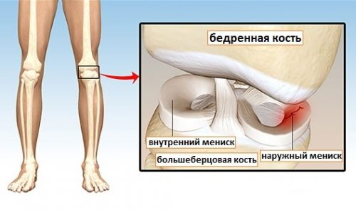Схема менисцита