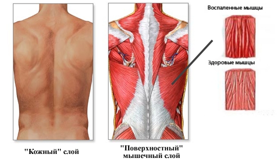 Миозит внизу спины Миозит внизу спины