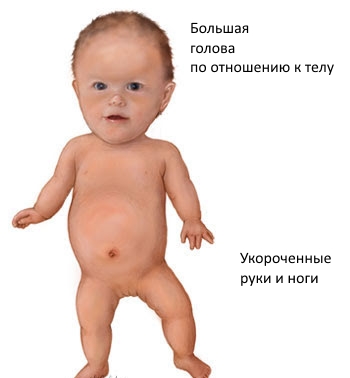 Признаки неравномерной карликовости