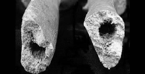 Несовершенный остеогенез костей Несовершенный остеогенез костей