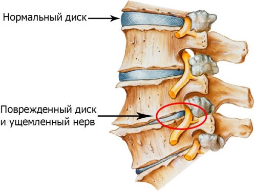 Остеохондроз позвоночника