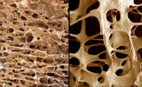 Остоепороз Остоепороз