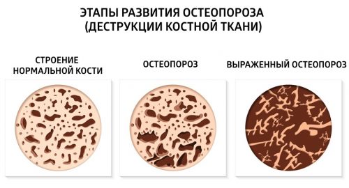 Этапы остеопороза