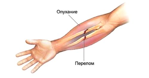 Перелом руки