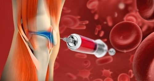 Плазмотерапия суставов Плазмотерапия суставов