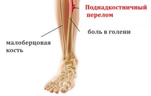 Поднадкостничный перелом голени Поднадкостничный перелом голени
