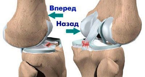 Повреждение мениска