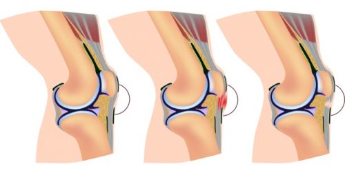 Повреждение коленной связки Повреждение коленной связки