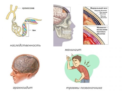 Частые причины сирингомиелии Частые причины сирингомиелии