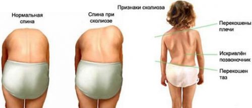 Признаки сколиоза у ребенка Признаки сколиоза у ребенка
