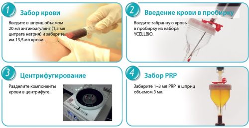 Этапы prp–терапии Этапы prp–терапии