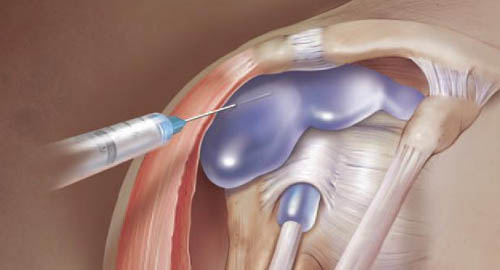 Пункция при синовите Пункция при синовите